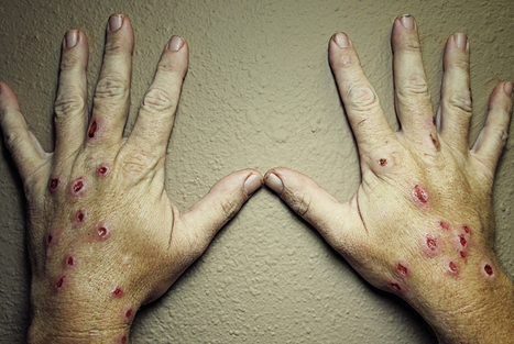 Вот так ужасно выглядят руки больного споротризозом человека