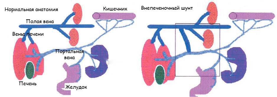 Портосистемный шунт 